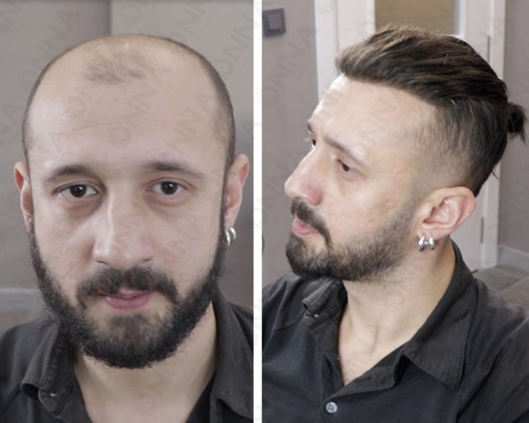 Protez Saç Takmak Caiz Mi?